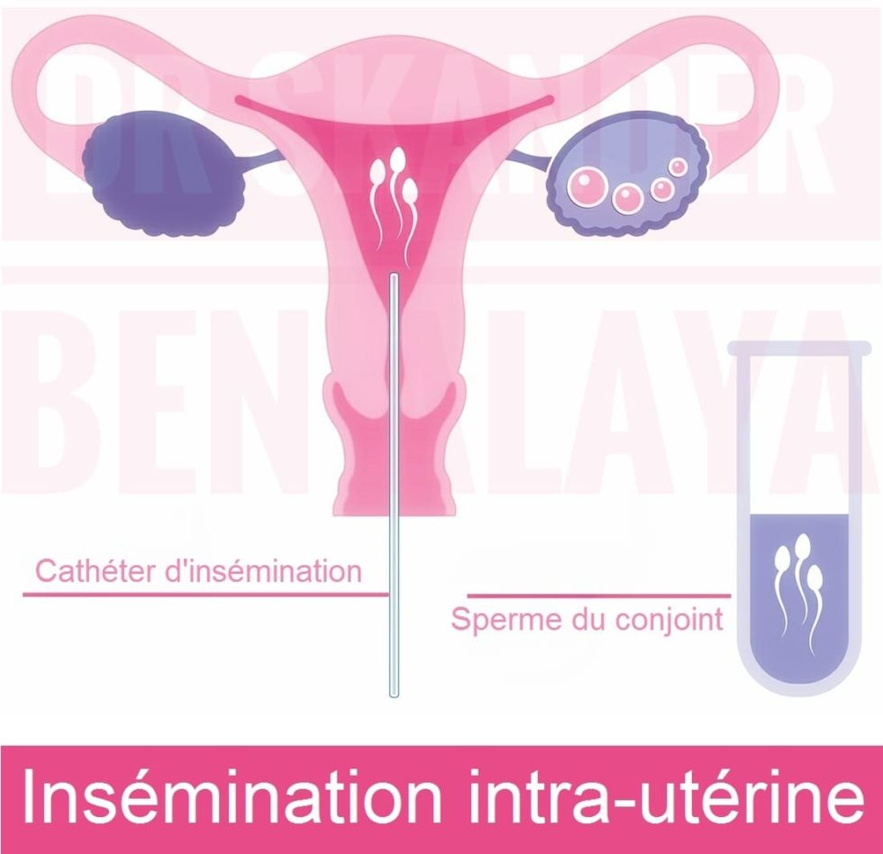 Ins Mination Artificielle Intra Ut Rine Avec Sperme Du Conjoint Iac