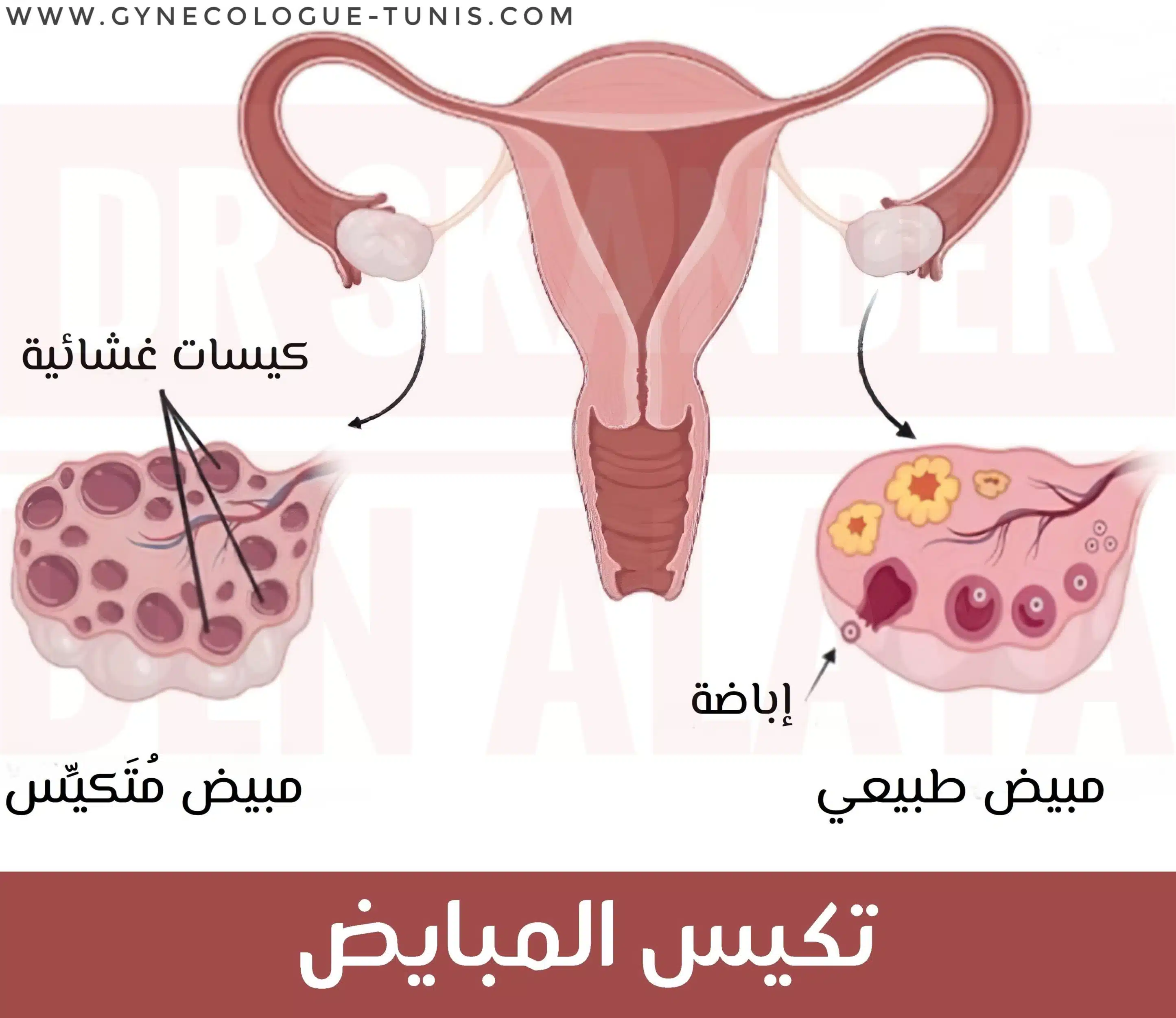 تكيس المبايض - متلازمة المبيض متعدد التكيسات