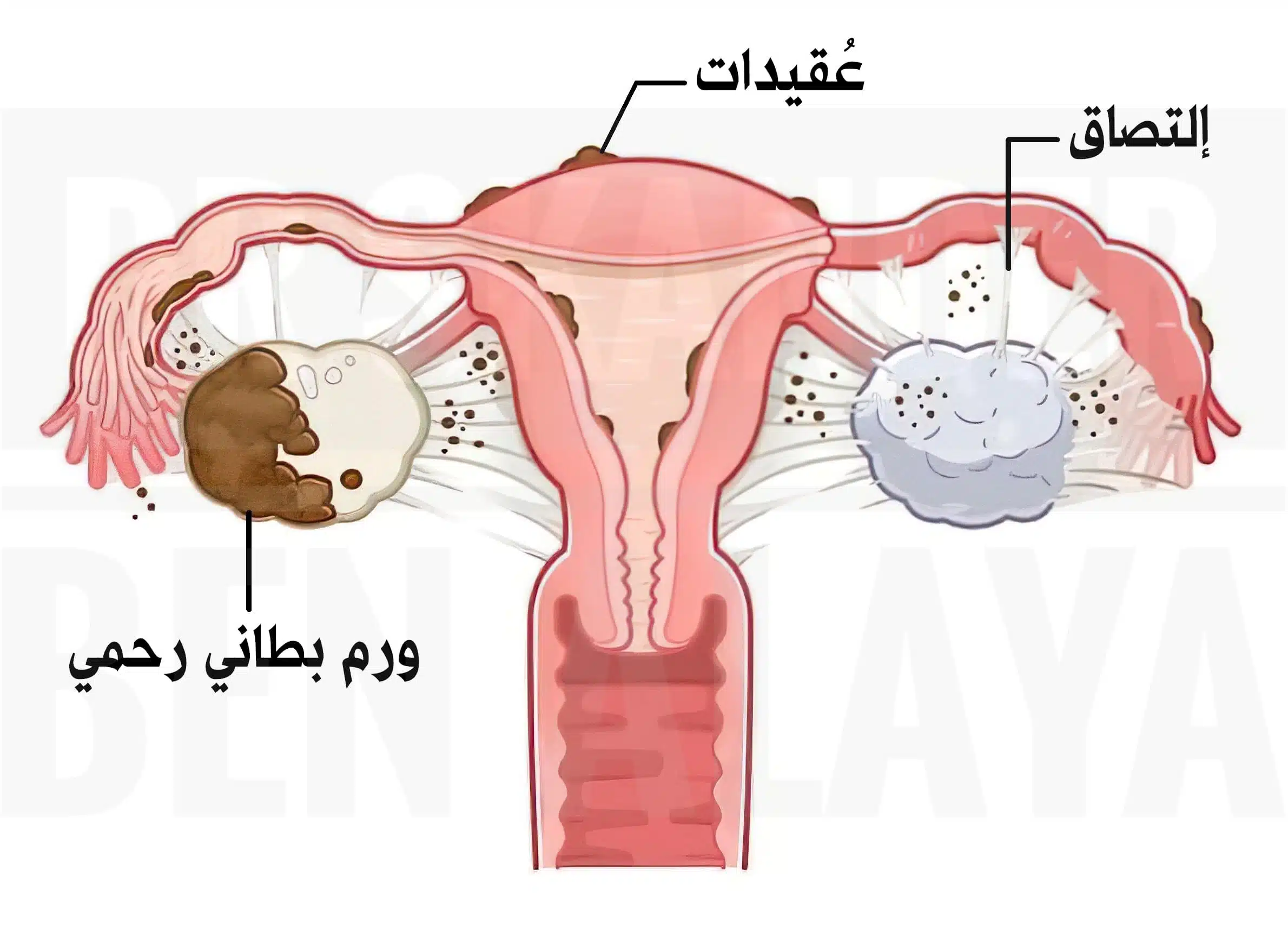 بطانة الرحم المهاجرة بطانة الرحم المهاجرة - الأعراض، الأسباب، التشخيص والعلاج