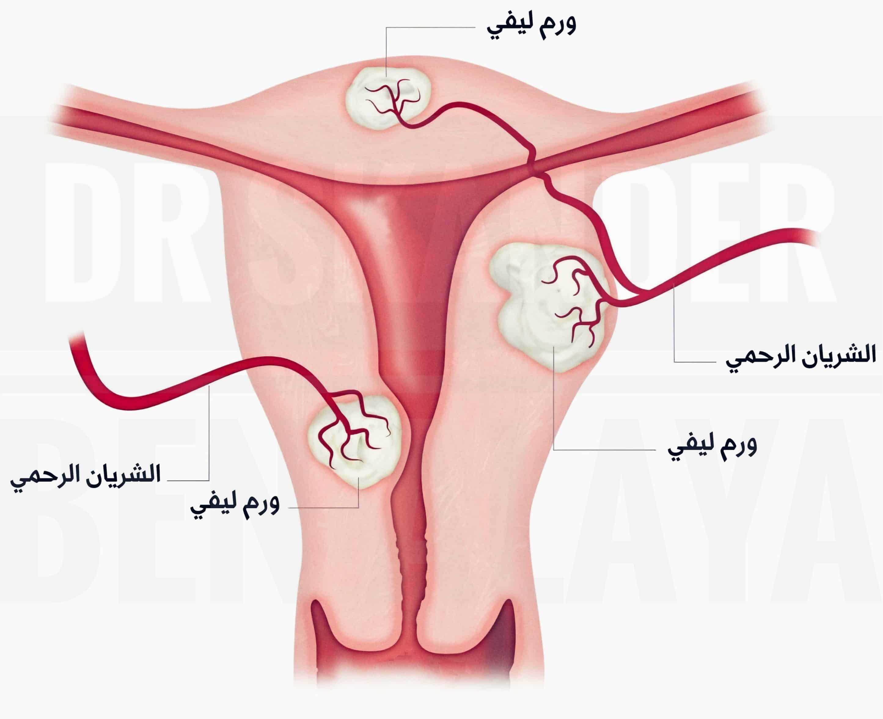 الأورام الليفية الرحمية، أورام ليفية في الرحم