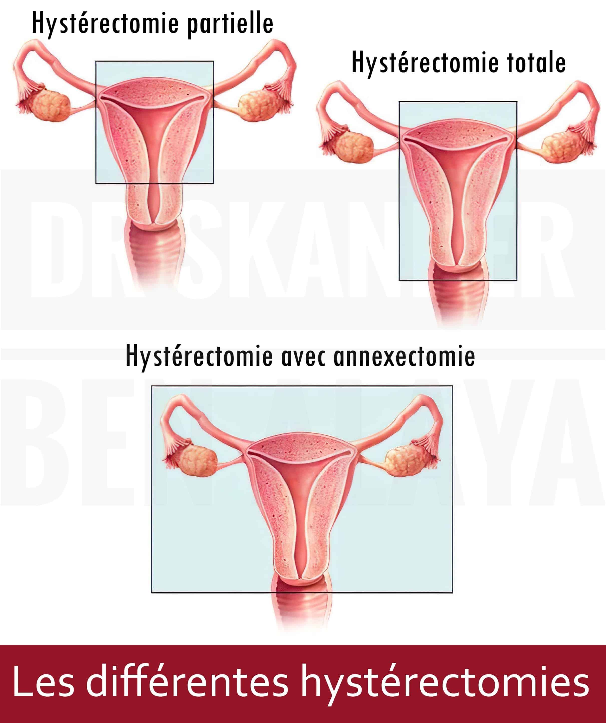 De nombreuses raisons peuvent amener un gynécologue à proposer une hystérectomie à sa patiente.