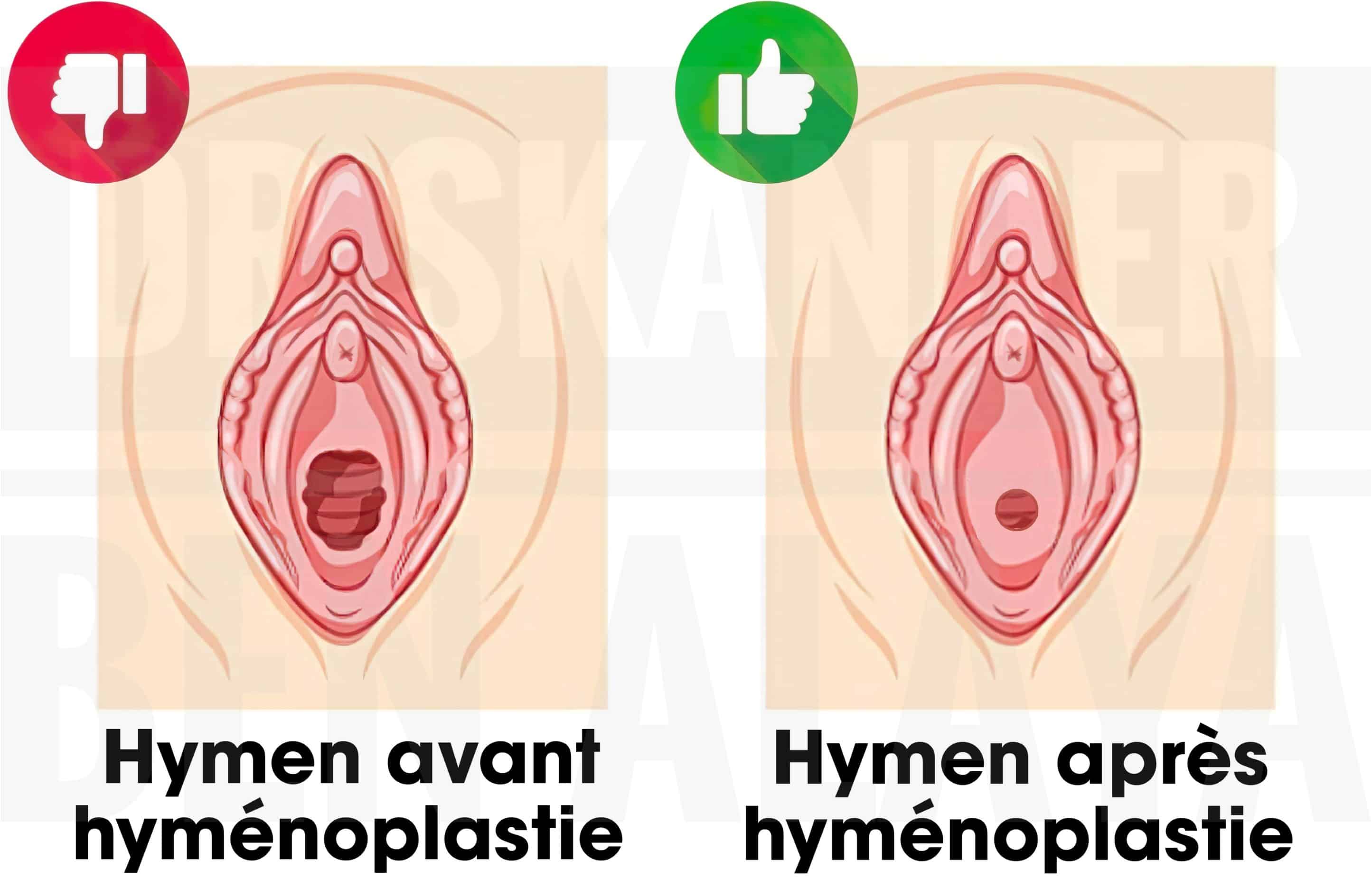 Une hyménoplastie est une reconstruction chirurgicale complète de l'hymen.