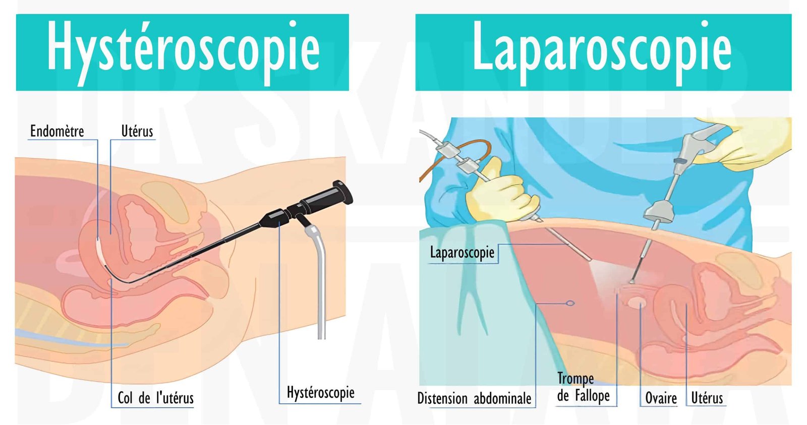 Image illustrant deux techniques de chirurgie endoscopique gynécologique : l’hystéroscopie par voie utérine et la laparoscopie par voie abdominale.
