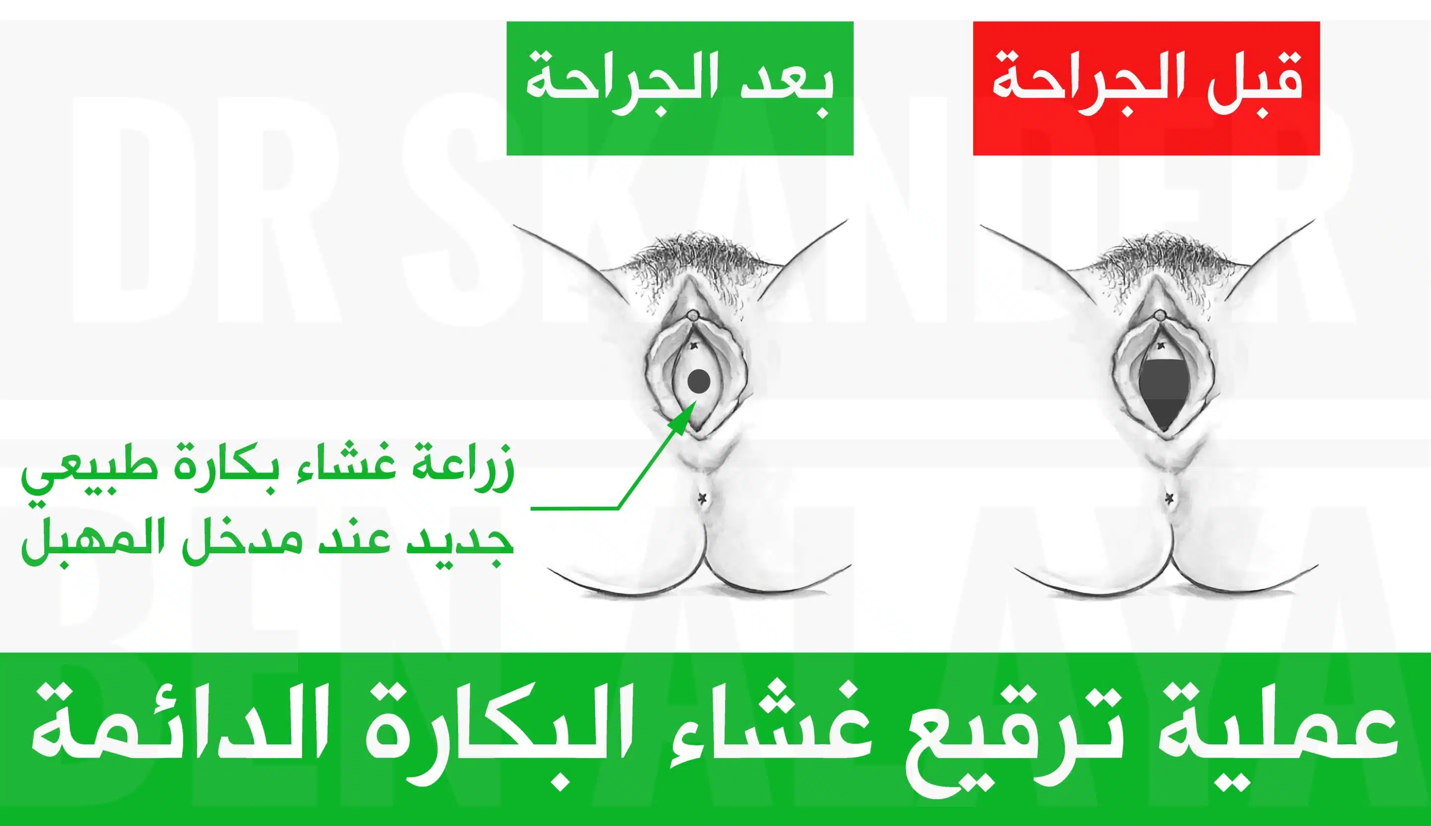 عملية ترقيع غشاء البكارة الدائمة (Hymenoplasty) عملية ترقيع غشاء البكارة الدائمة بإستخدام سديلة مهبلية مأخوذة من الجدار الخلفي أو الجانبي للمهبل.
