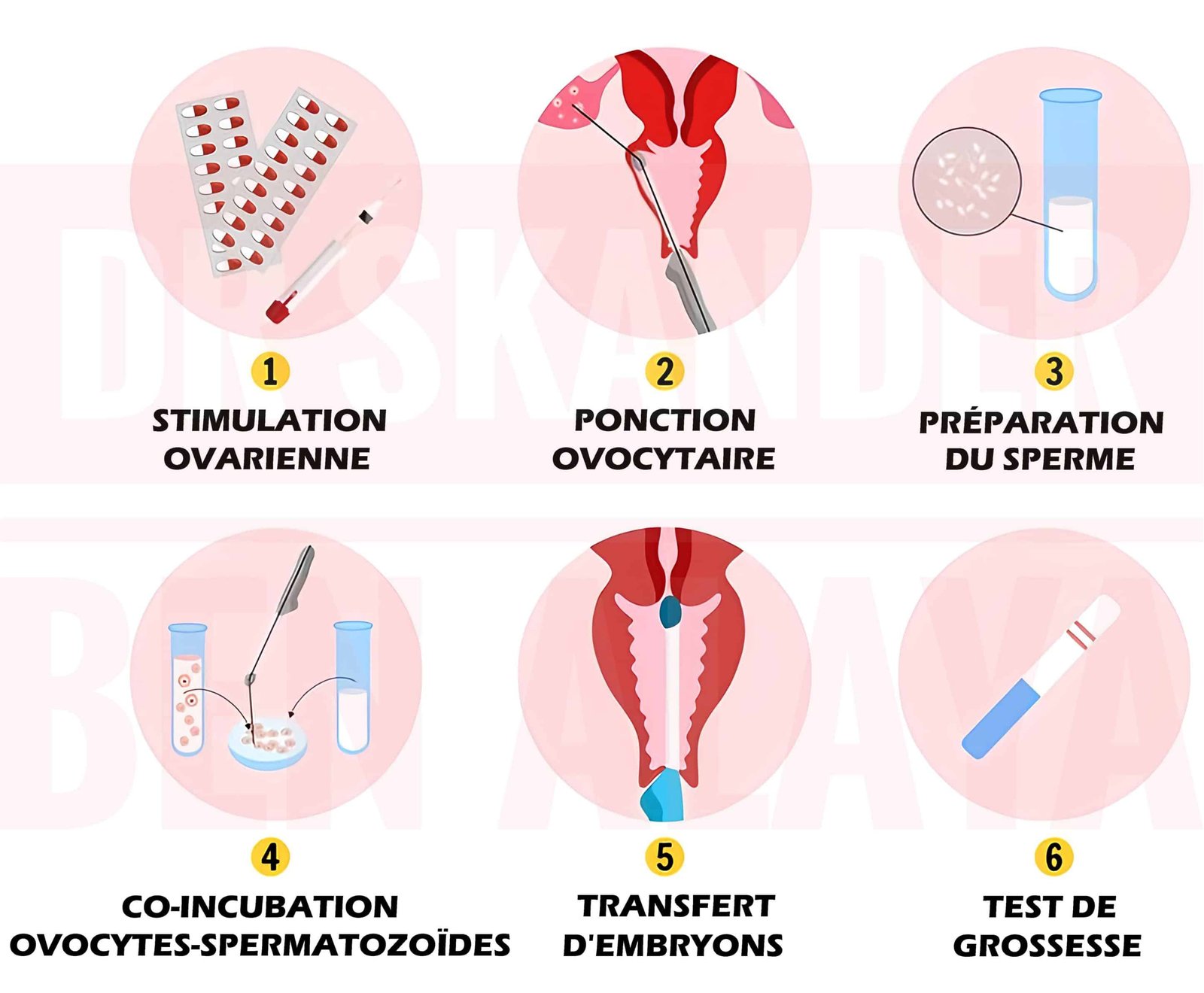 Les étapes de la fécondation in vitro (FIV) étape par étape