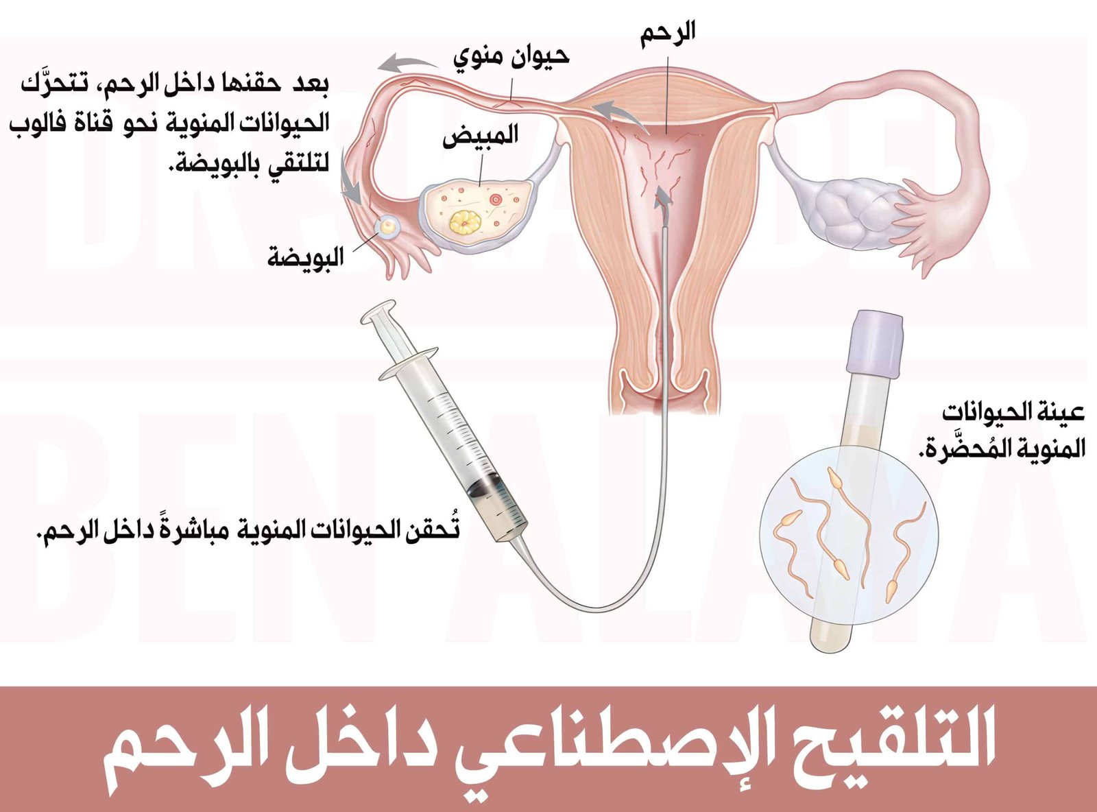 المراحل والخطوات التي يتضمنها التلقيح الاصطناعي داخل الرحم