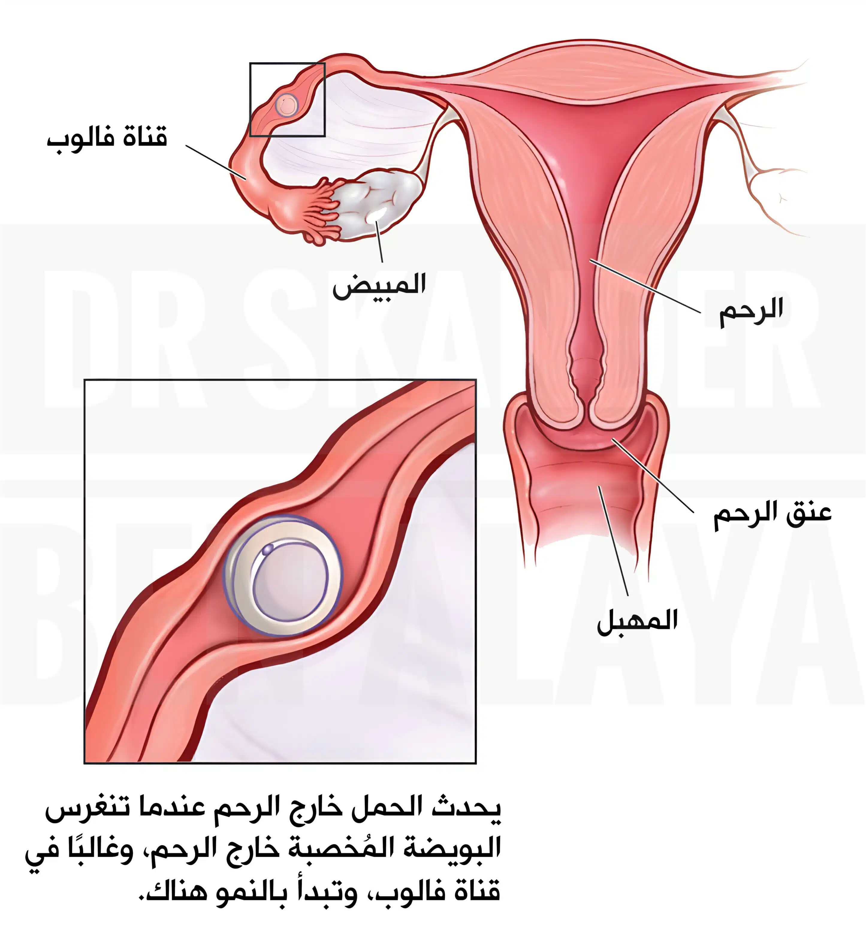 الحمل خارج الرحم الحمل خارج الرحم داخل قناة فالوب